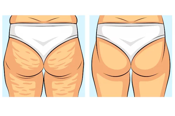 Cellulite Reduction