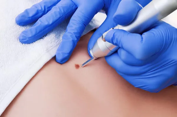 Mole, Skin Tags and Wart Removal