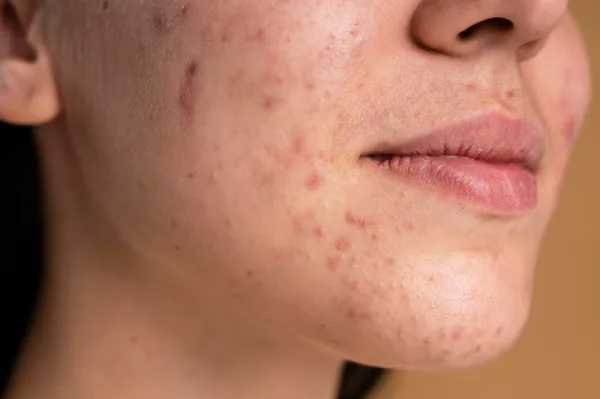 Acne And Acne Scar Treatment