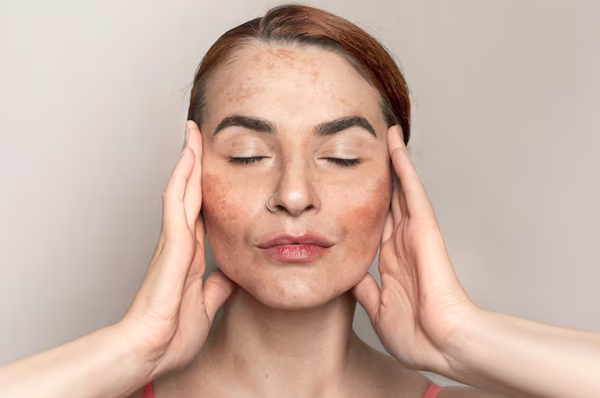 Melasma Management