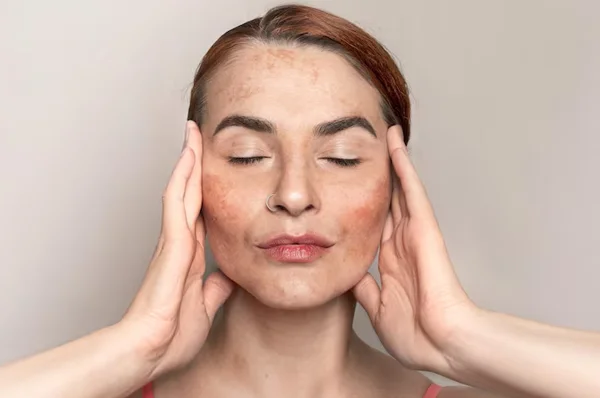 Melasma Management