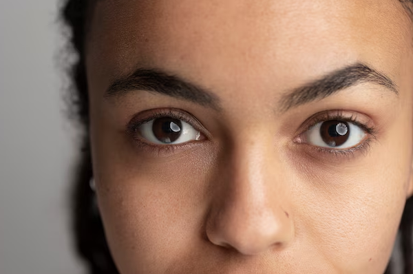Undereye Dark Circles