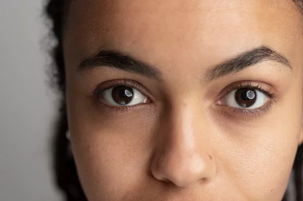 Undereye Dark Circles