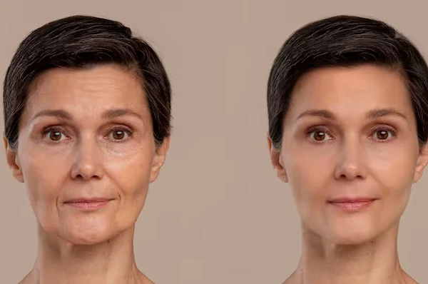Fine Lines Wrinkles Reduction