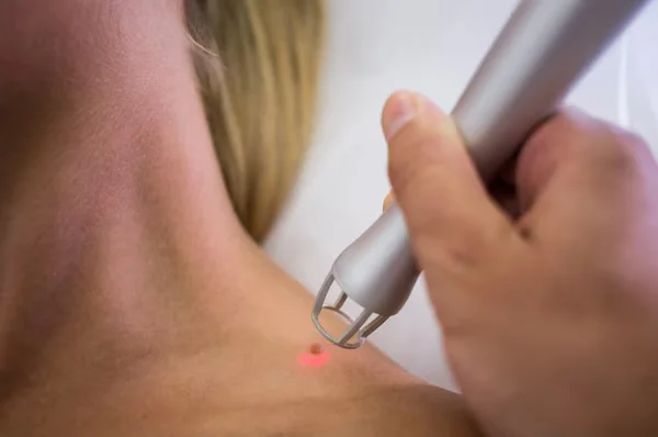 Mole Removal