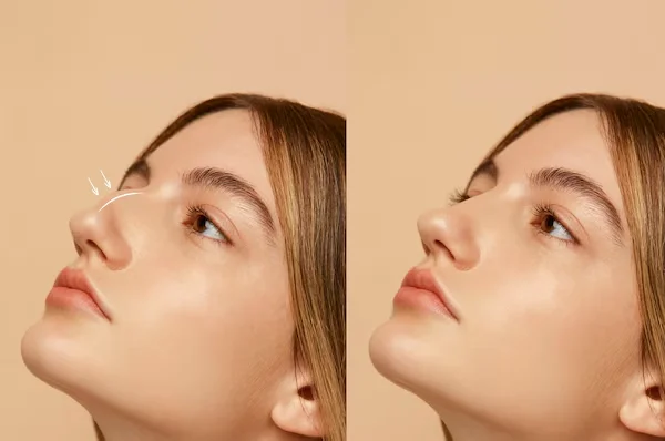 Nose Filler