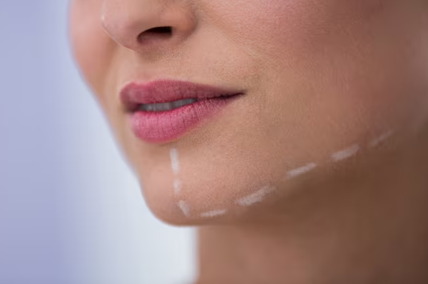 Chin Filler
