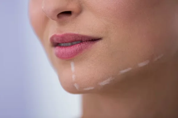 Chin Filler