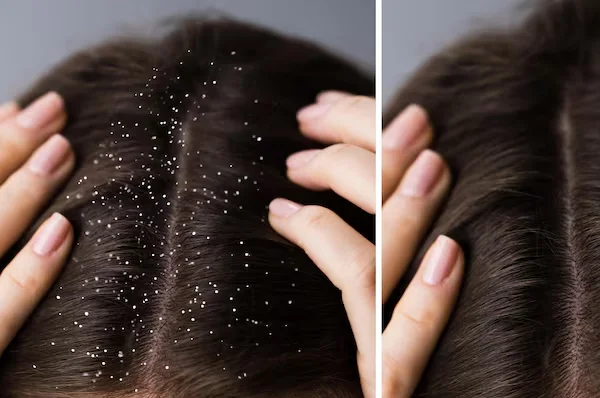 Dandruff Treatment