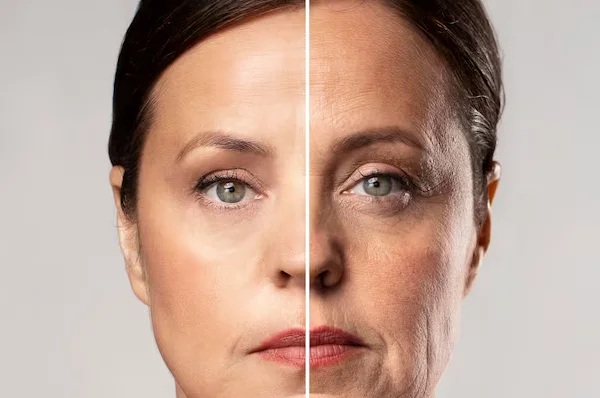 Derma Fillers