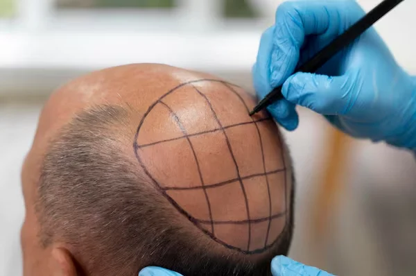 Scalp Micropigmentation