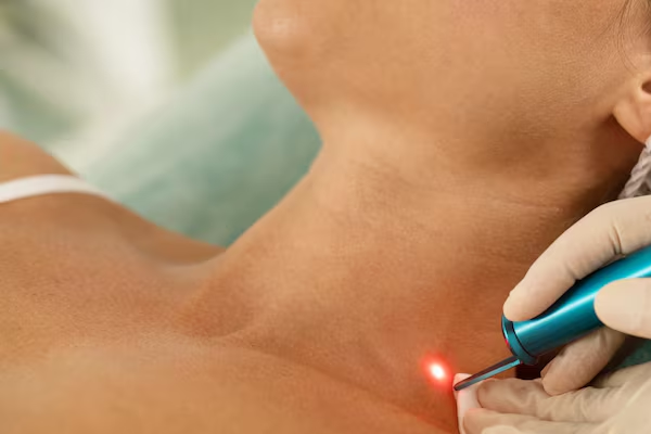 Birthmark Removal