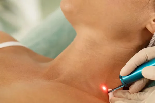 Birthmark Removal